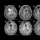 Estudo busca aperfeioar o diagnstico por imagem da esquizofrenia